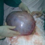 Phẫu thuật lấy u năng buồng trứng